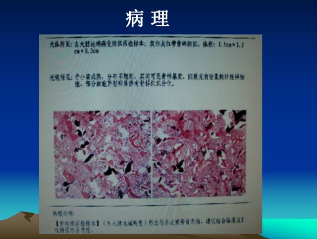 【PPT】恶性骨肿瘤的影像学诊断
