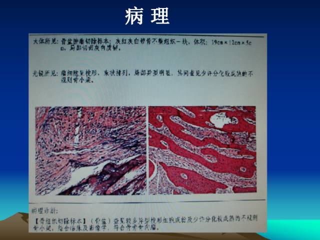 【PPT】恶性骨肿瘤的影像学诊断