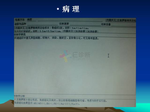【PPT】恶性骨肿瘤的影像学诊断