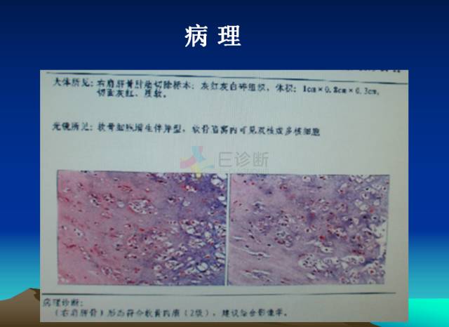 【PPT】恶性骨肿瘤的影像学诊断