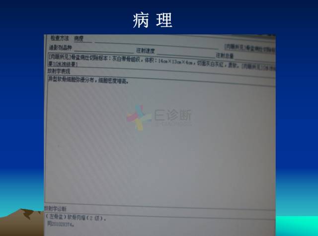 【PPT】恶性骨肿瘤的影像学诊断