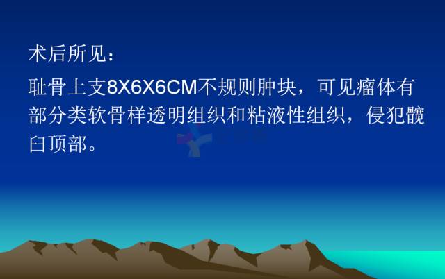 【PPT】恶性骨肿瘤的影像学诊断