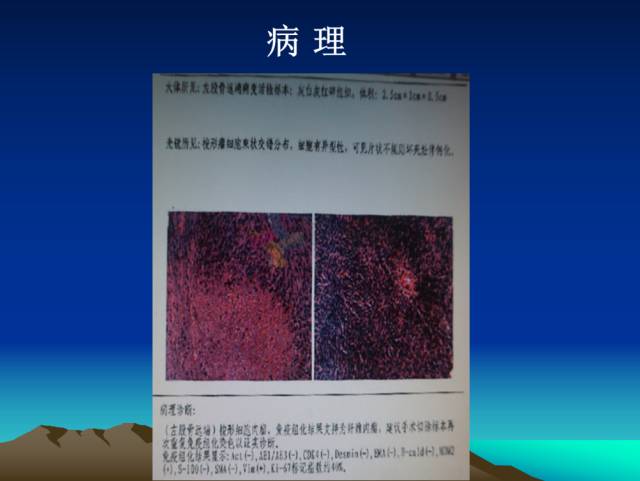 【PPT】恶性骨肿瘤的影像学诊断