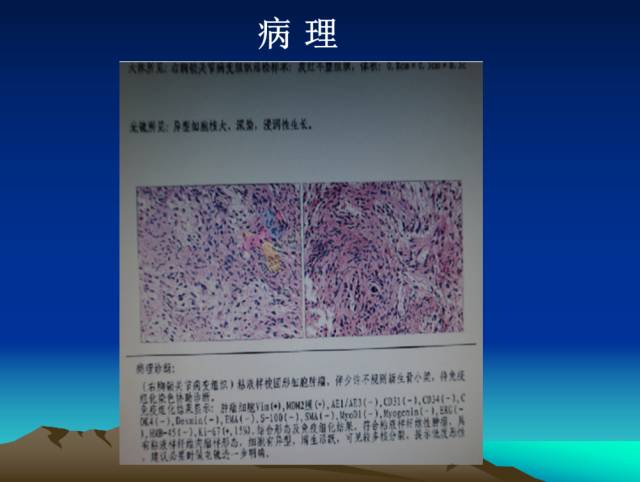 【PPT】恶性骨肿瘤的影像学诊断