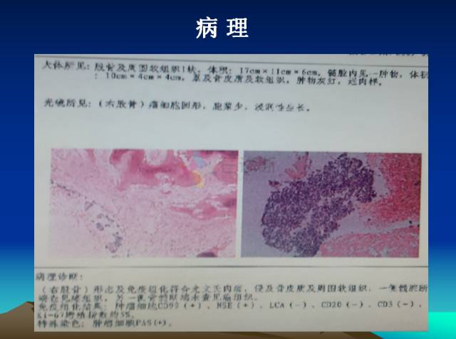【PPT】恶性骨肿瘤的影像学诊断