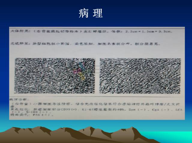 【PPT】恶性骨肿瘤的影像学诊断