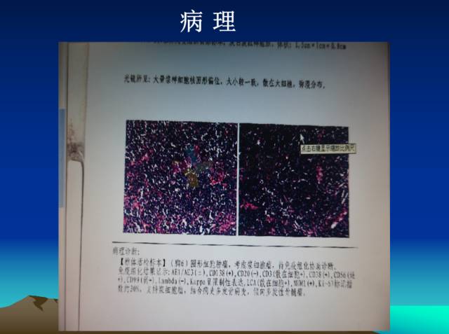 【PPT】恶性骨肿瘤的影像学诊断
