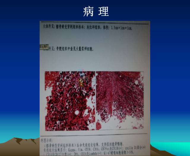 【PPT】恶性骨肿瘤的影像学诊断