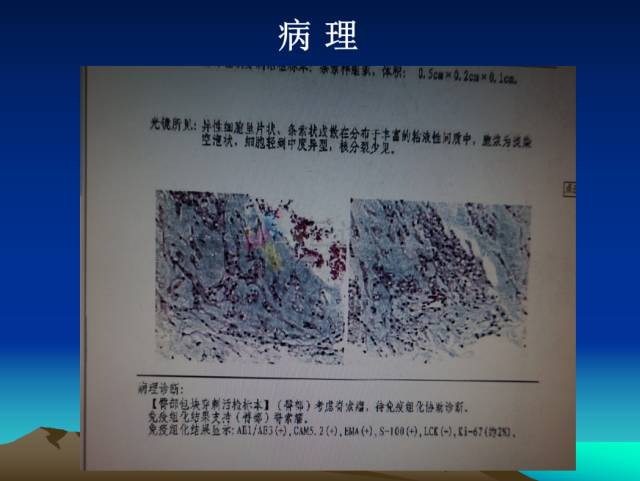 【PPT】恶性骨肿瘤的影像学诊断