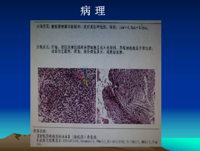 【PPT】恶性骨肿瘤的影像学诊断