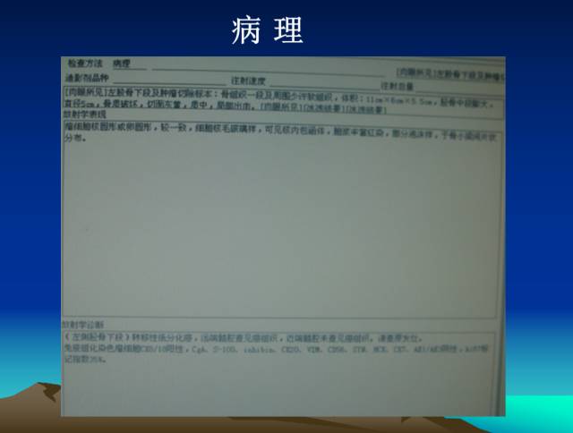 【PPT】恶性骨肿瘤的影像学诊断