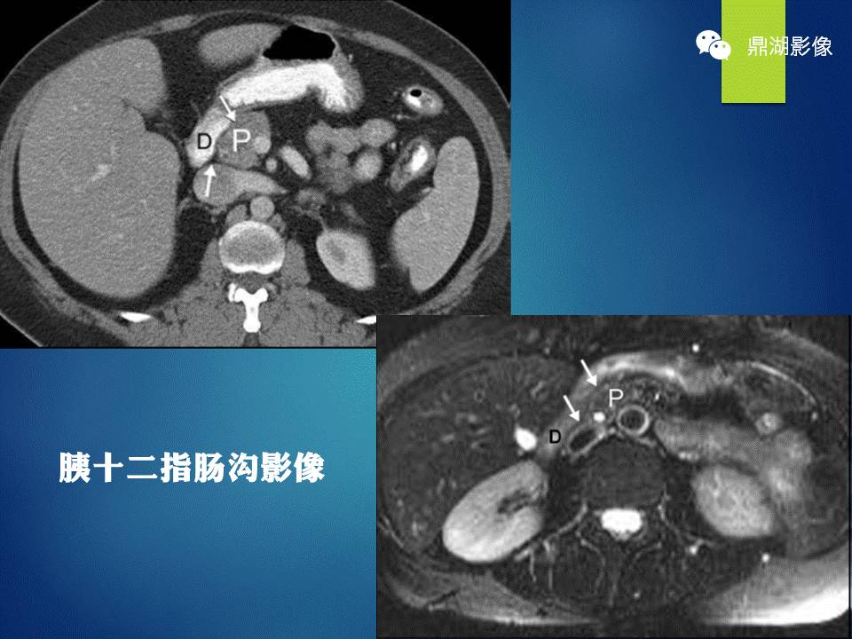 【PPT】胰十二指肠沟部胰腺炎的影像诊断与鉴别诊断