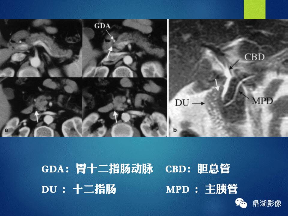 【PPT】胰十二指肠沟部胰腺炎的影像诊断与鉴别诊断