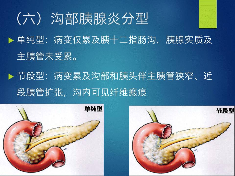 【PPT】胰十二指肠沟部胰腺炎的影像诊断与鉴别诊断