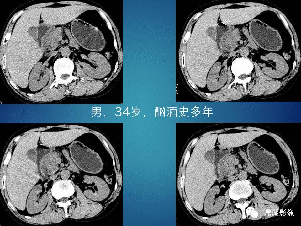 【PPT】胰十二指肠沟部胰腺炎的影像诊断与鉴别诊断