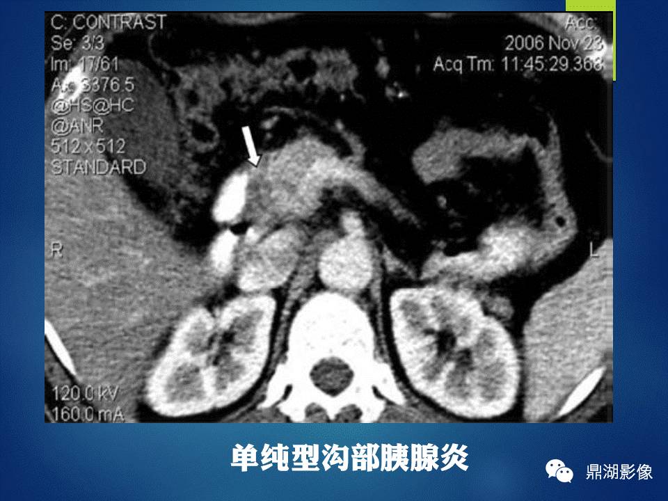 【PPT】胰十二指肠沟部胰腺炎的影像诊断与鉴别诊断