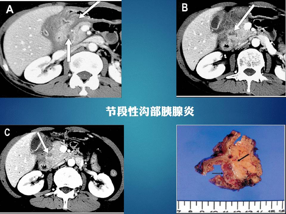 【PPT】胰十二指肠沟部胰腺炎的影像诊断与鉴别诊断