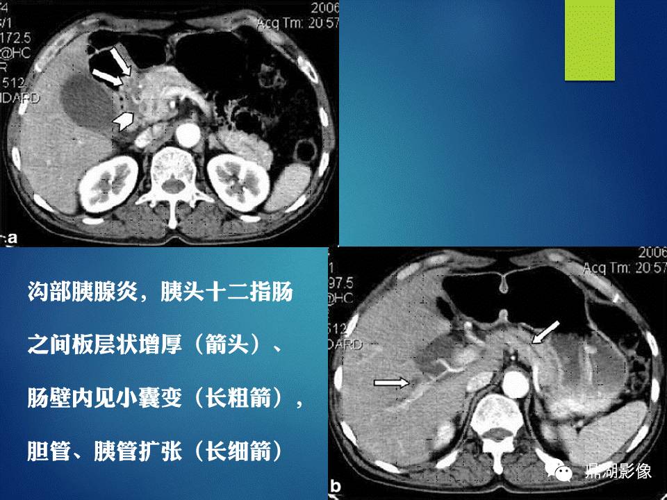 【PPT】胰十二指肠沟部胰腺炎的影像诊断与鉴别诊断