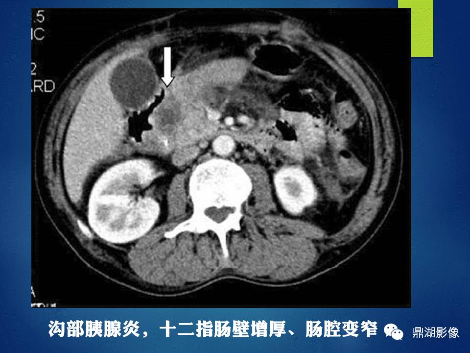 【PPT】胰十二指肠沟部胰腺炎的影像诊断与鉴别诊断