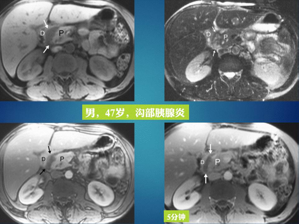 【PPT】胰十二指肠沟部胰腺炎的影像诊断与鉴别诊断