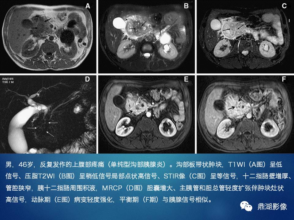 【PPT】胰十二指肠沟部胰腺炎的影像诊断与鉴别诊断