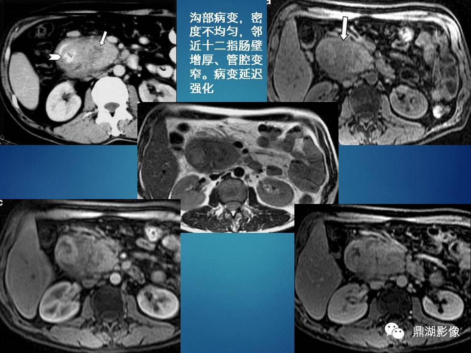【PPT】胰十二指肠沟部胰腺炎的影像诊断与鉴别诊断