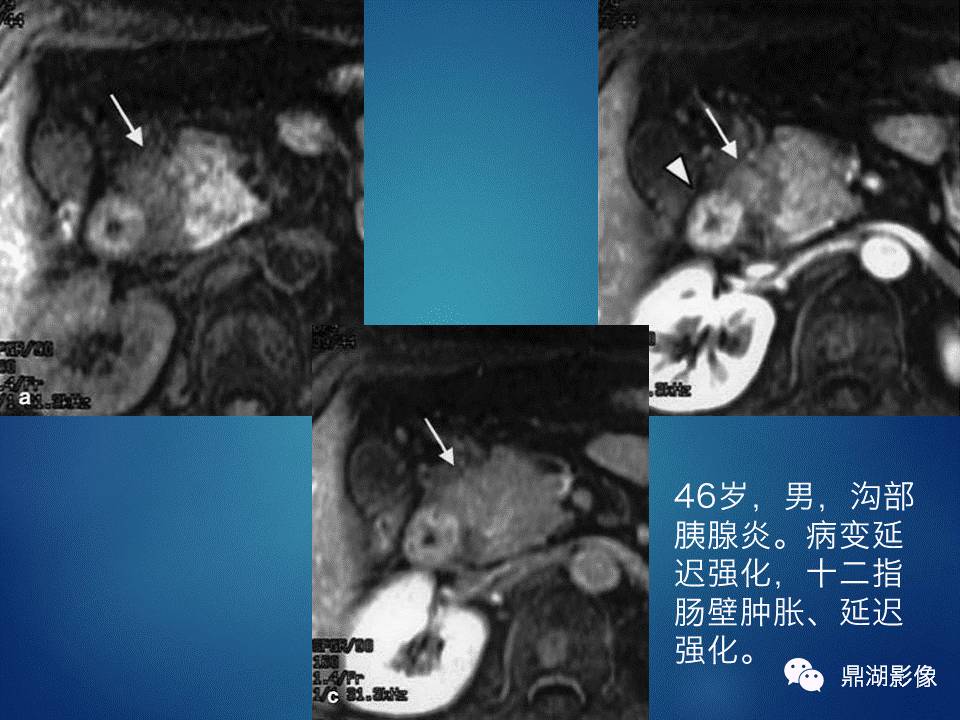 【PPT】胰十二指肠沟部胰腺炎的影像诊断与鉴别诊断