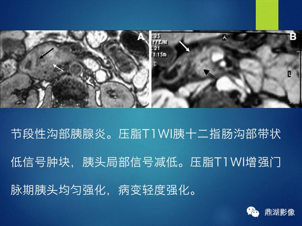 【PPT】胰十二指肠沟部胰腺炎的影像诊断与鉴别诊断