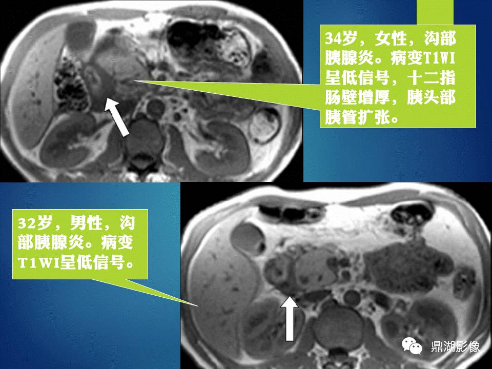 【PPT】胰十二指肠沟部胰腺炎的影像诊断与鉴别诊断
