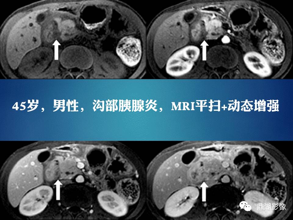 【PPT】胰十二指肠沟部胰腺炎的影像诊断与鉴别诊断