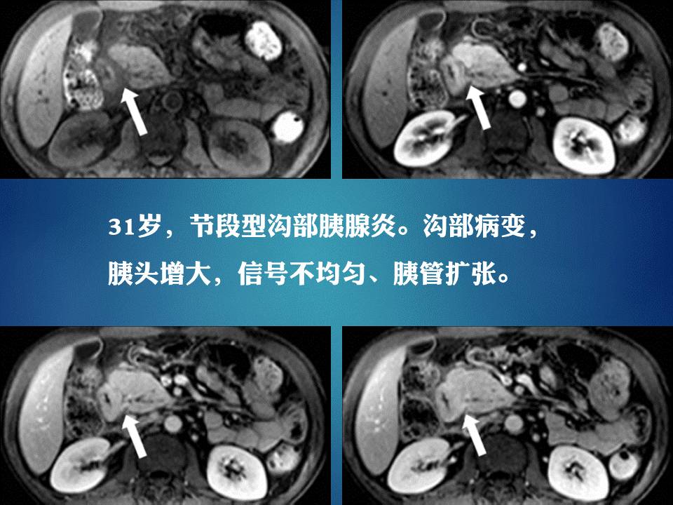 【PPT】胰十二指肠沟部胰腺炎的影像诊断与鉴别诊断