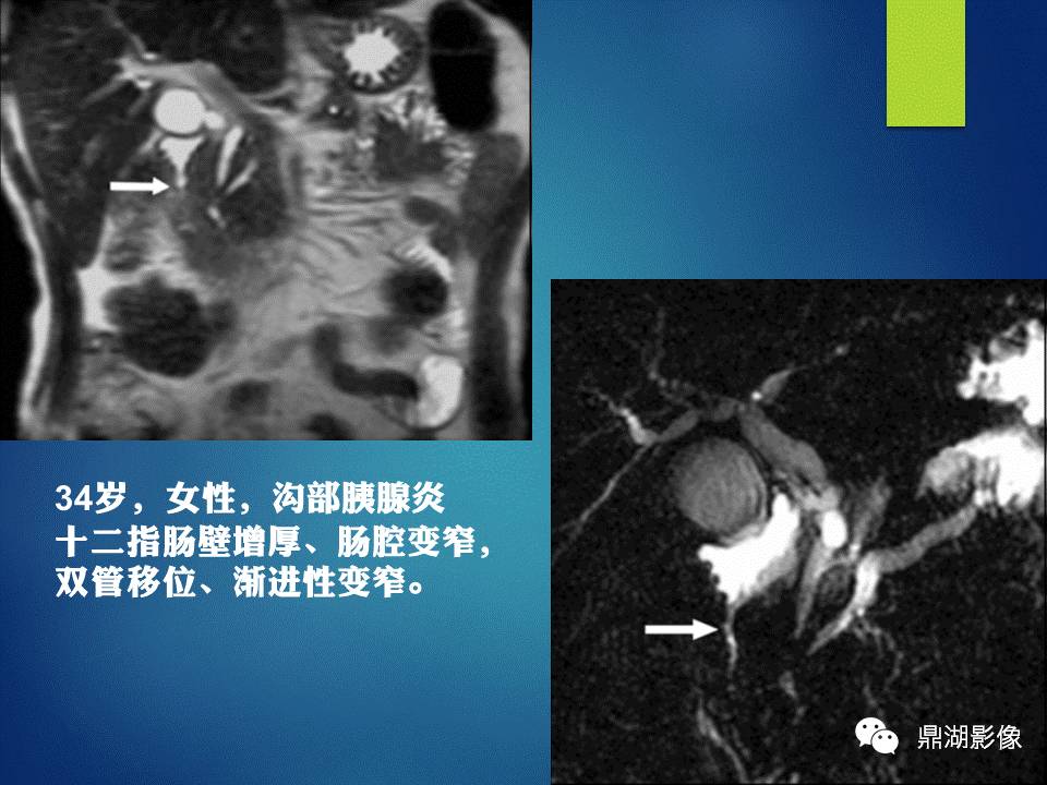 【PPT】胰十二指肠沟部胰腺炎的影像诊断与鉴别诊断