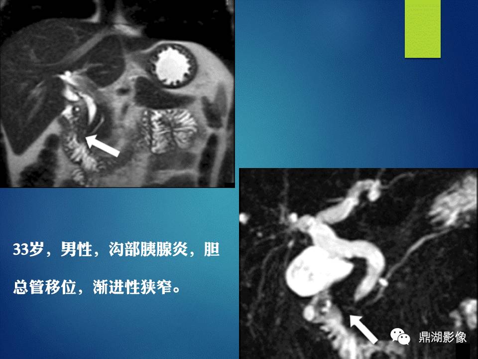【PPT】胰十二指肠沟部胰腺炎的影像诊断与鉴别诊断