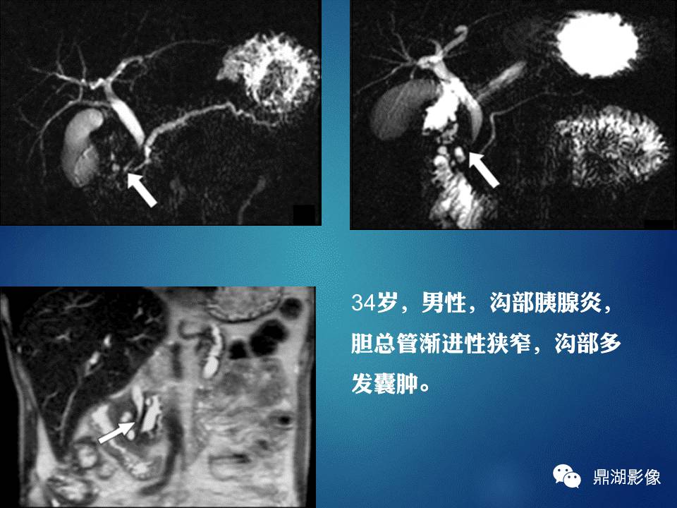 【PPT】胰十二指肠沟部胰腺炎的影像诊断与鉴别诊断
