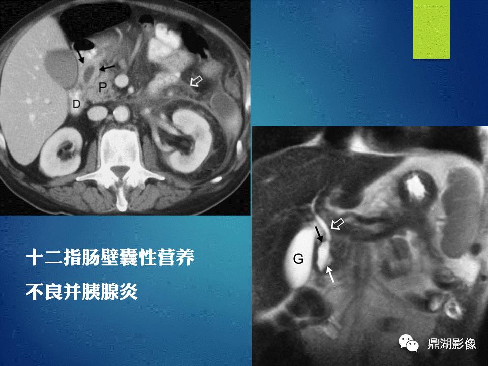 【PPT】胰十二指肠沟部胰腺炎的影像诊断与鉴别诊断