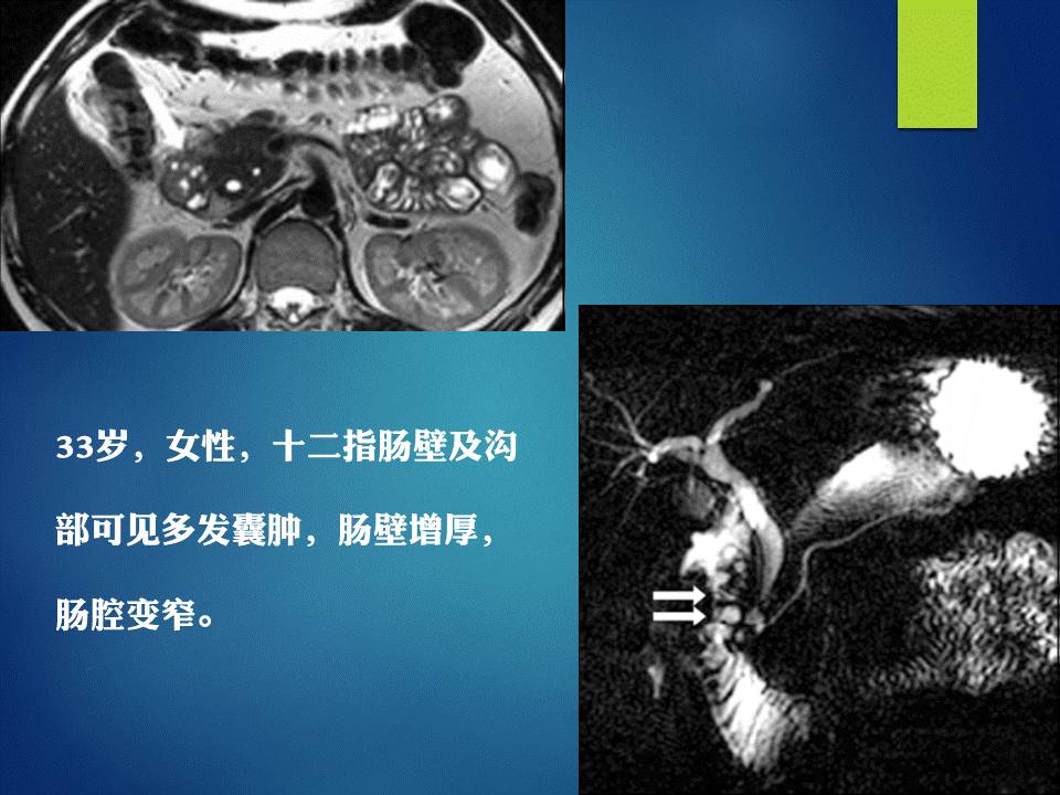 【PPT】胰十二指肠沟部胰腺炎的影像诊断与鉴别诊断