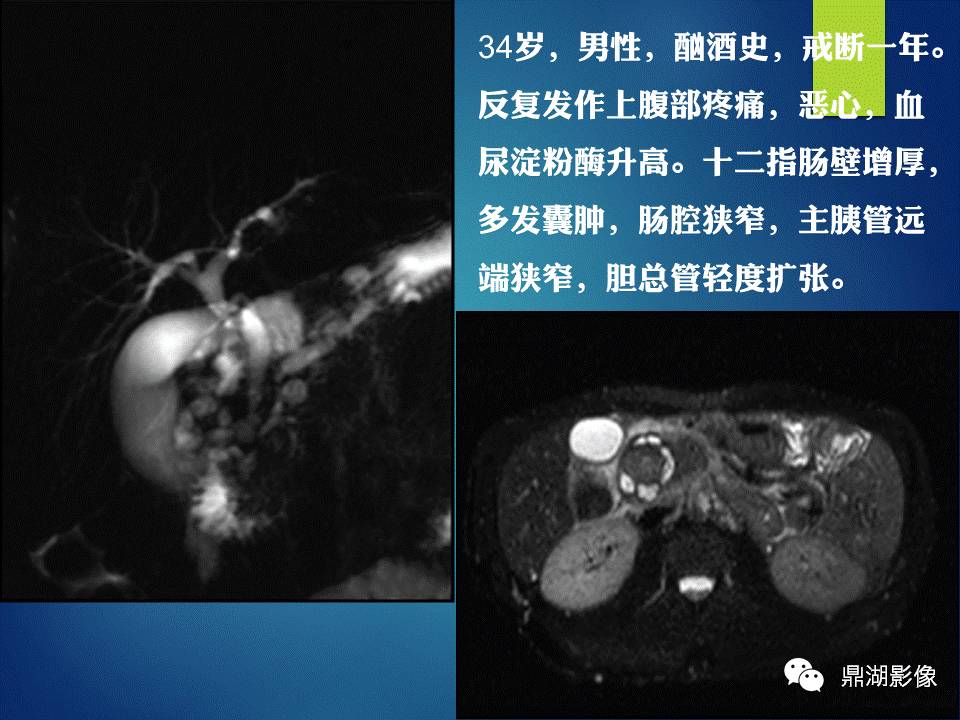 【PPT】胰十二指肠沟部胰腺炎的影像诊断与鉴别诊断