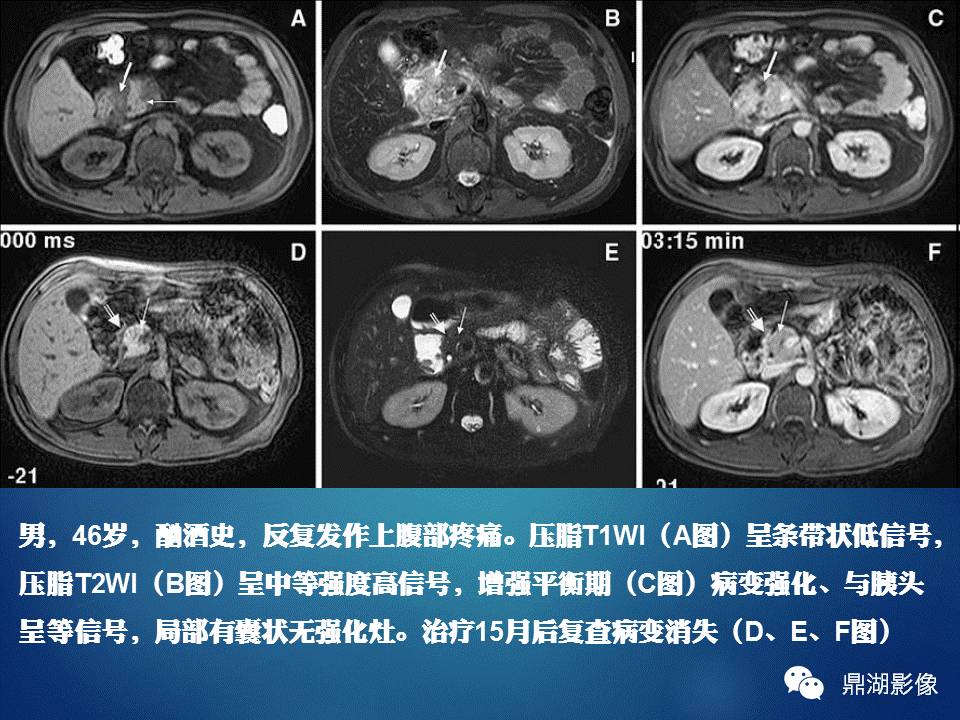【PPT】胰十二指肠沟部胰腺炎的影像诊断与鉴别诊断