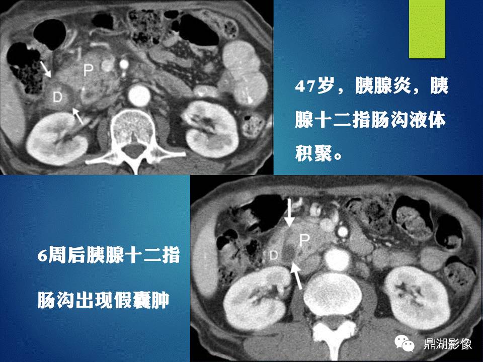 【PPT】胰十二指肠沟部胰腺炎的影像诊断与鉴别诊断