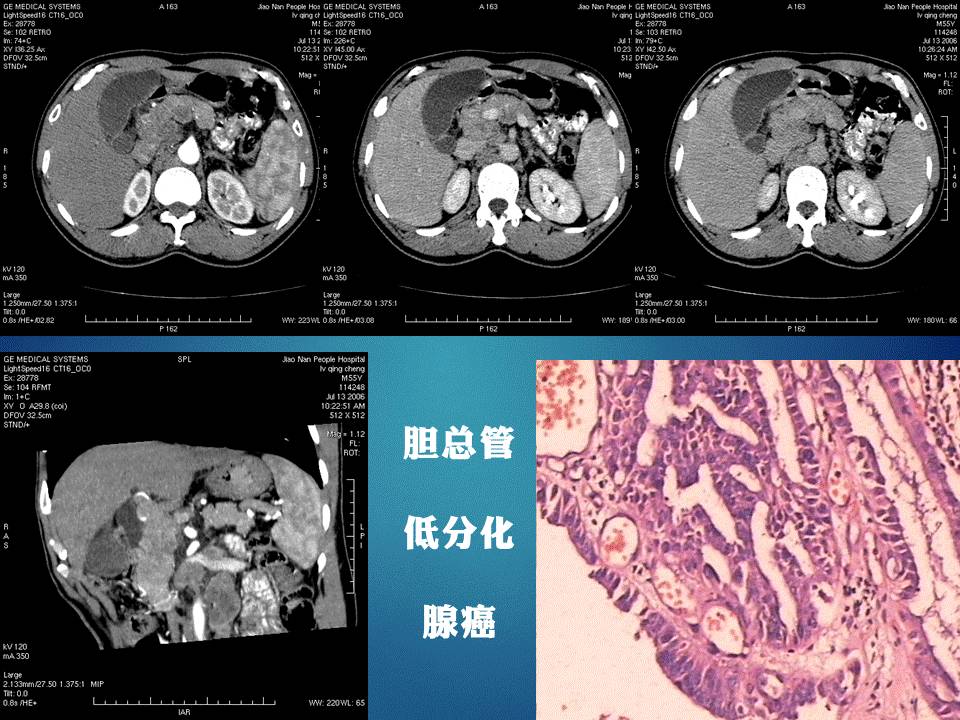 【PPT】胰十二指肠沟部胰腺炎的影像诊断与鉴别诊断
