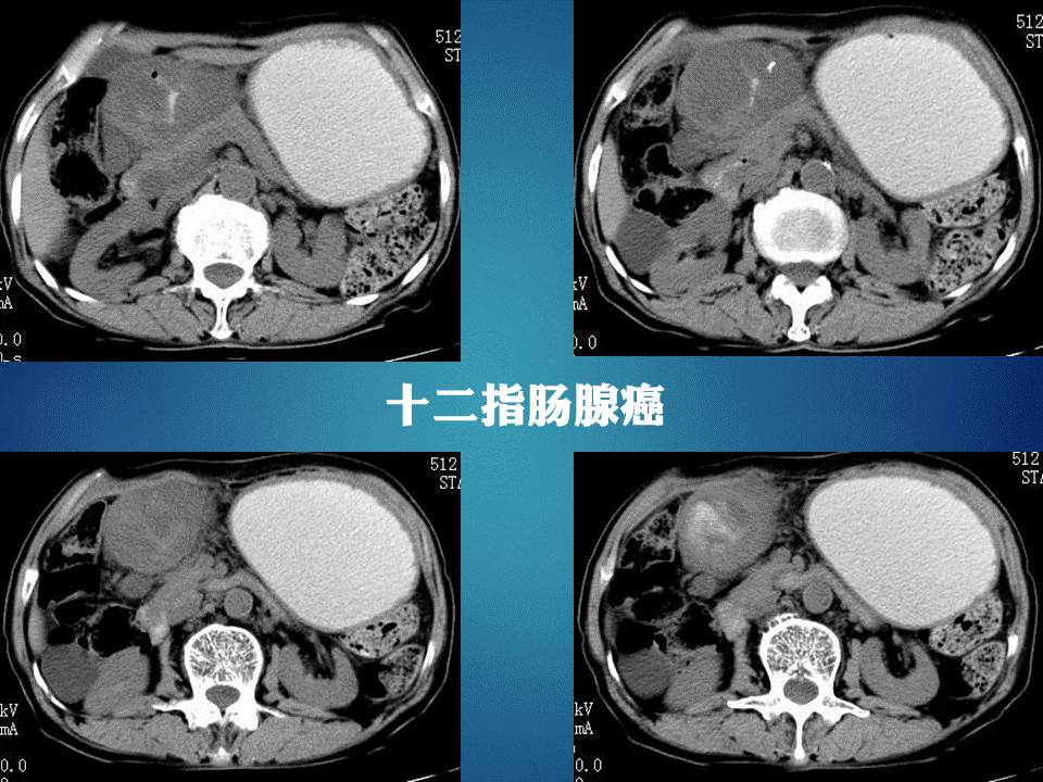 【PPT】胰十二指肠沟部胰腺炎的影像诊断与鉴别诊断