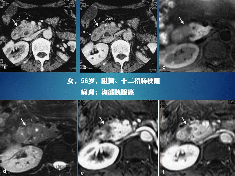 【PPT】胰十二指肠沟部胰腺炎的影像诊断与鉴别诊断