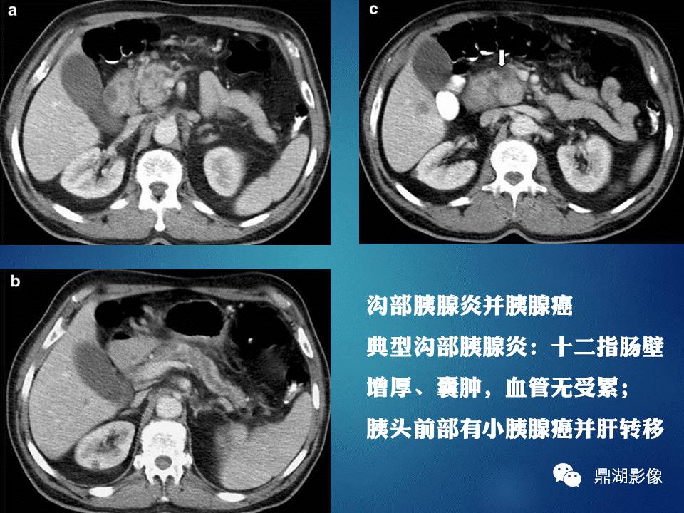 【PPT】胰十二指肠沟部胰腺炎的影像诊断与鉴别诊断