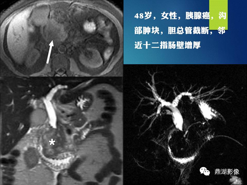 【PPT】胰十二指肠沟部胰腺炎的影像诊断与鉴别诊断