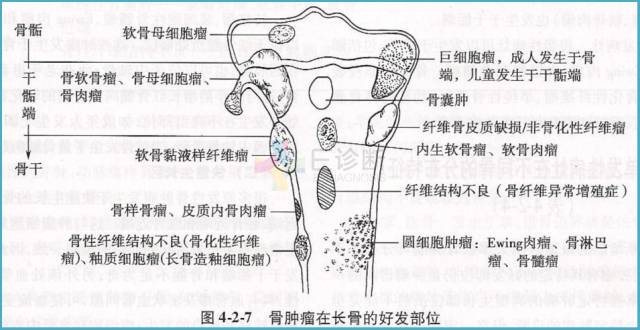【PPT】良恶性骨肿瘤：影像诊断和图像特征