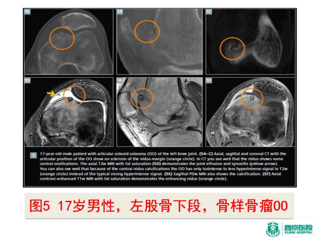 【PPT】良恶性骨肿瘤：影像诊断和图像特征