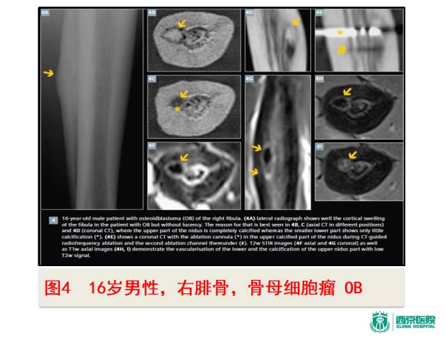 【PPT】良恶性骨肿瘤：影像诊断和图像特征
