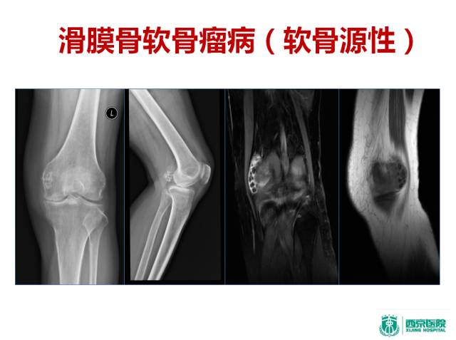 【PPT】良恶性骨肿瘤：影像诊断和图像特征