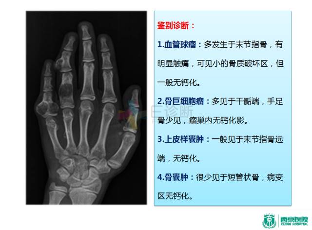 【PPT】良恶性骨肿瘤：影像诊断和图像特征