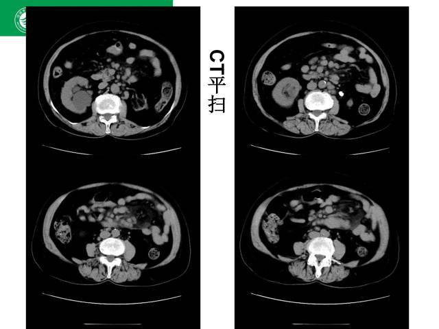 【病例】肠系膜根部淋巴瘤1例CT影像表现 【病例】肠系膜根部淋巴瘤1例CT影像表现